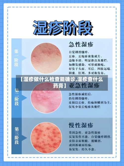 【湿疹做什么检查能确诊,湿疹查什么药膏】