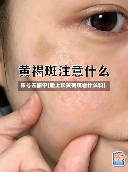 限号去榆中(脸上长黄褐斑看什么科)