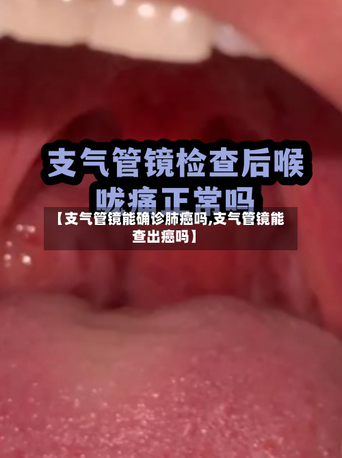【支气管镜能确诊肺癌吗,支气管镜能查出癌吗】-第3张图片