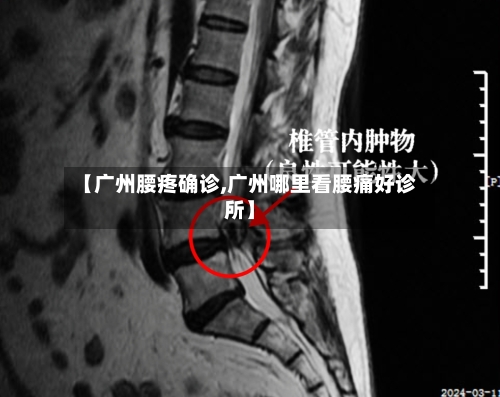 【广州腰疼确诊,广州哪里看腰痛好诊所】-第2张图片