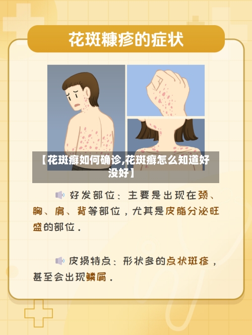 【花斑癣如何确诊,花斑癣怎么知道好没好】-第2张图片