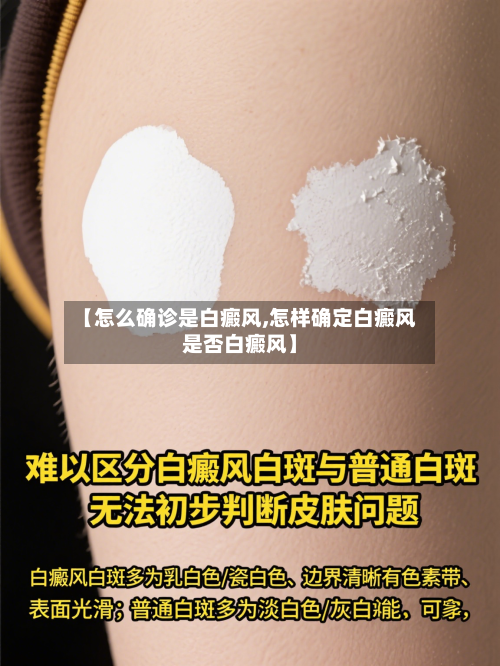 【怎么确诊是白癜风,怎样确定白癜风是否白癜风】