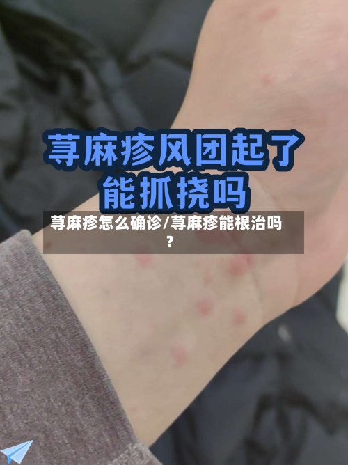 荨麻疹怎么确诊/荨麻疹能根治吗?-第3张图片