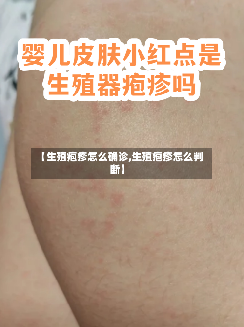 【生殖疱疹怎么确诊,生殖疱疹怎么判断】