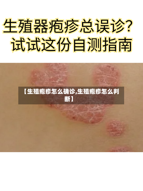 【生殖疱疹怎么确诊,生殖疱疹怎么判断】-第2张图片