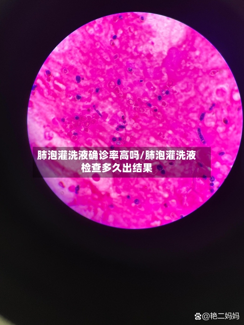 肺泡灌洗液确诊率高吗/肺泡灌洗液检查多久出结果-第2张图片