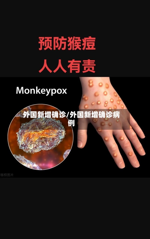 外国新增确诊/外国新增确诊病例-第2张图片