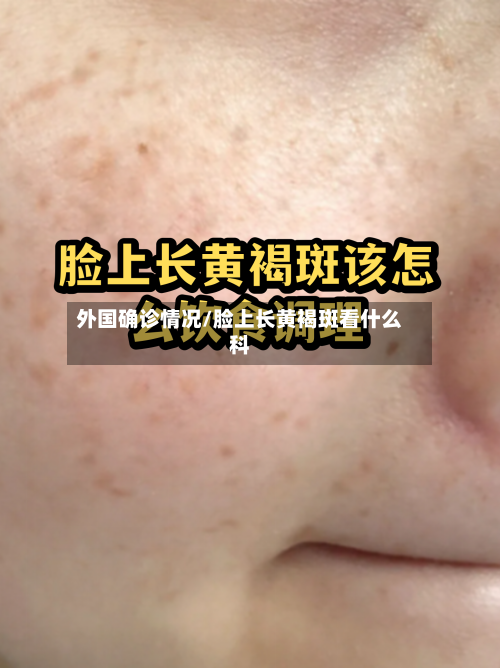 外国确诊情况/脸上长黄褐斑看什么科