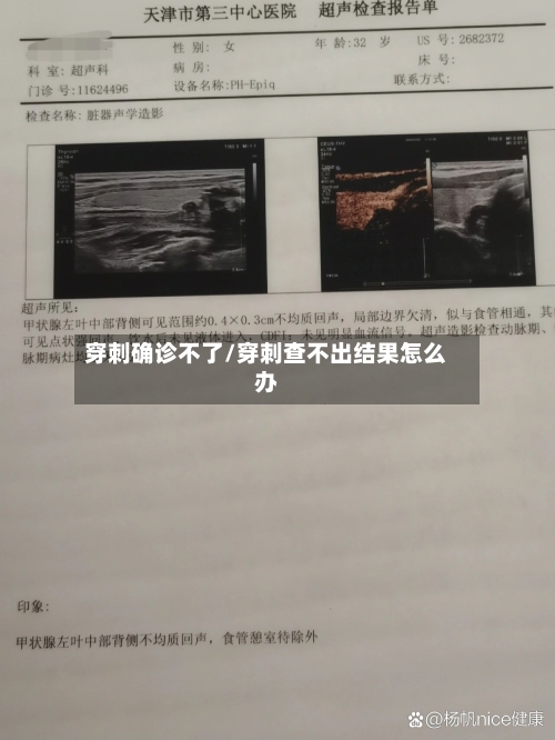 穿刺确诊不了/穿刺查不出结果怎么办