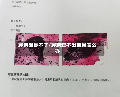 穿刺确诊不了/穿刺查不出结果怎么办-第3张图片