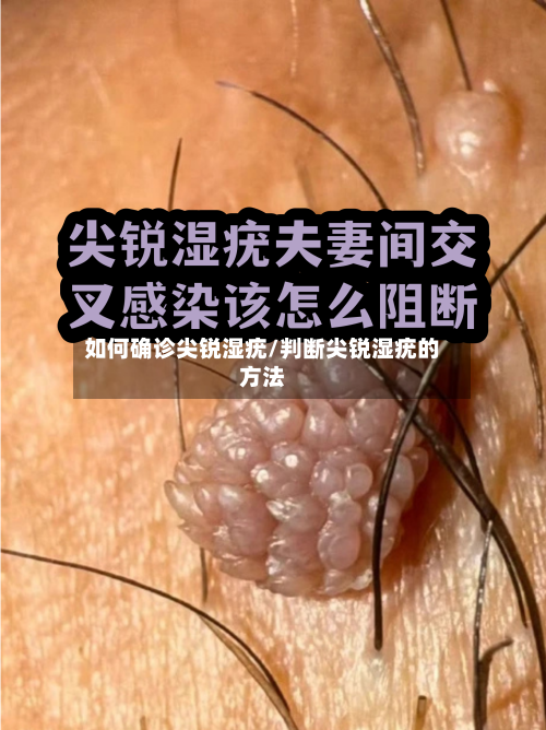 如何确诊尖锐湿疣/判断尖锐湿疣的方法