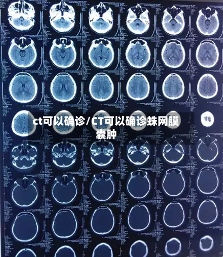 ct可以确诊/CT可以确诊蛛网膜囊肿-第2张图片