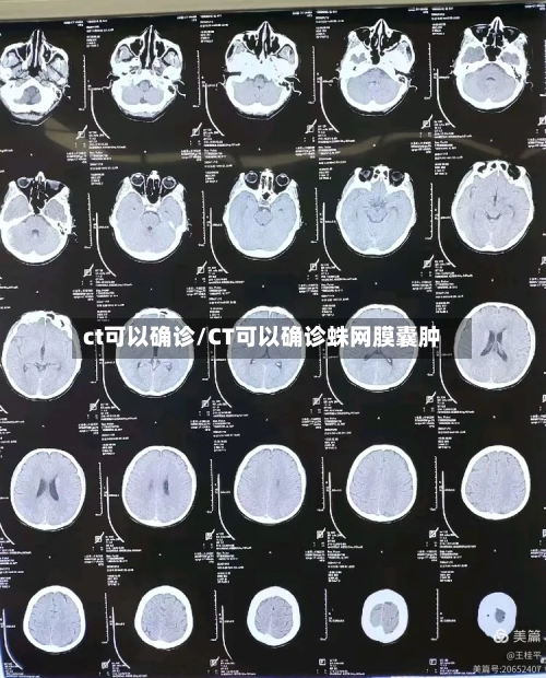 ct可以确诊/CT可以确诊蛛网膜囊肿-第3张图片