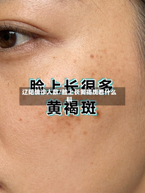 辽阳确诊人数/脸上长黄褐斑看什么科