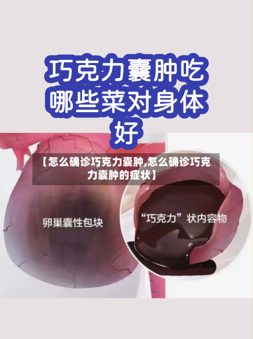 【怎么确诊巧克力囊肿,怎么确诊巧克力囊肿的症状】