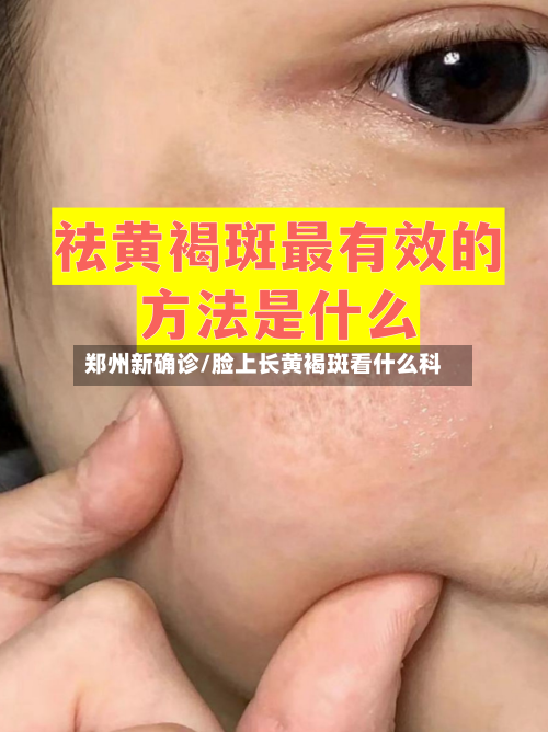 郑州新确诊/脸上长黄褐斑看什么科