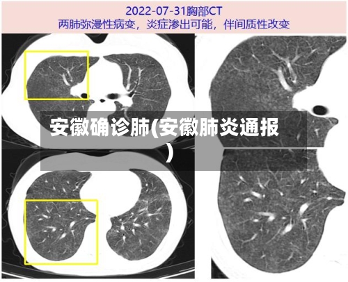 安徽确诊肺(安徽肺炎通报)