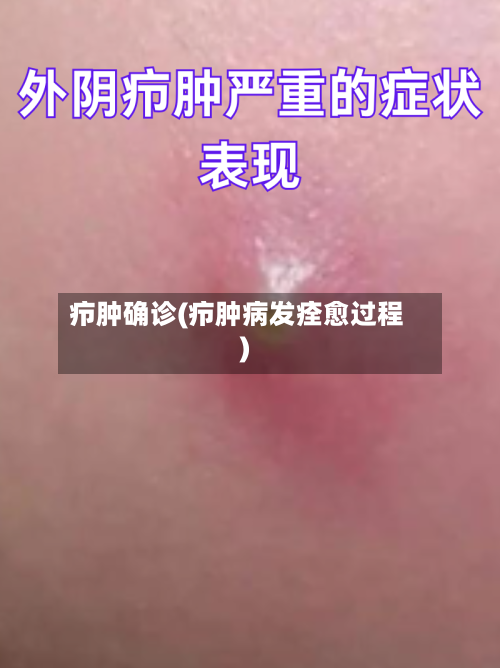 疖肿确诊(疖肿病发痊愈过程)