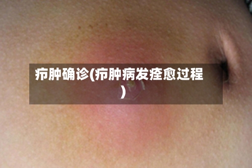 疖肿确诊(疖肿病发痊愈过程)-第3张图片