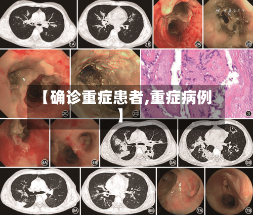 【确诊重症患者,重症病例】