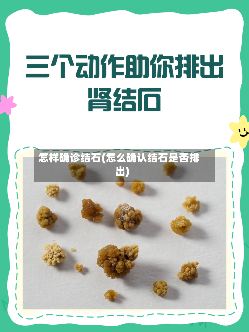怎样确诊结石(怎么确认结石是否排出)-第2张图片