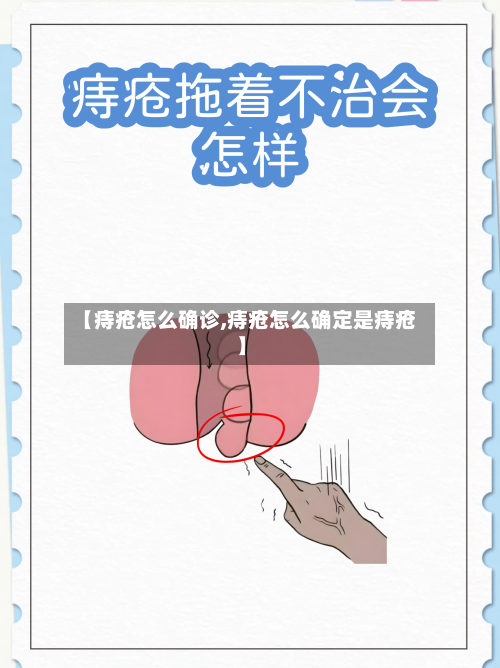 【痔疮怎么确诊,痔疮怎么确定是痔疮】-第1张图片