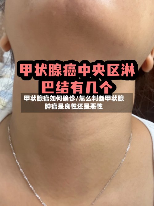 甲状腺瘤如何确诊/怎么判断甲状腺肿瘤是良性还是恶性