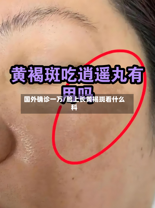 国外确诊一万/脸上长黄褐斑看什么科-第2张图片