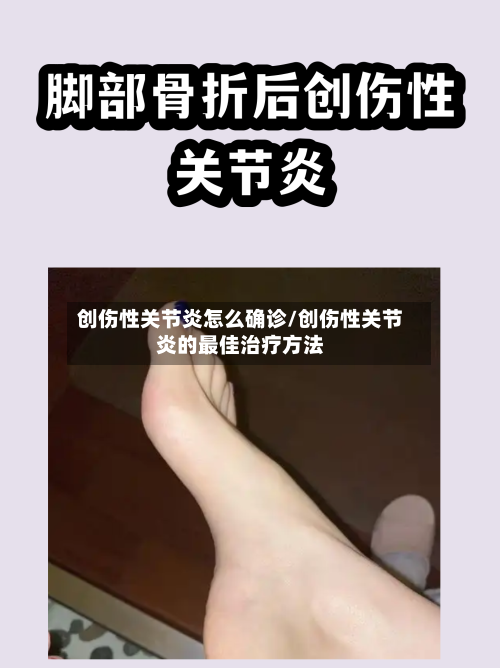 创伤性关节炎怎么确诊/创伤性关节炎的最佳治疗方法
