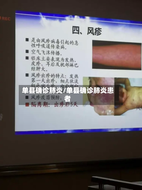 单县确诊肺炎/单县确诊肺炎患者